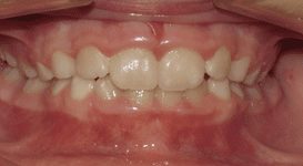 Ava-After-Teeth