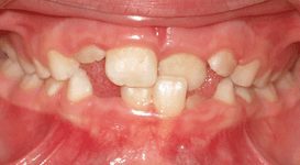Ava-Before-Teeth
