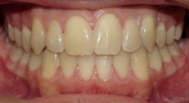 Dakota-After-Teeth