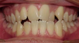 Dakota-Before-Teeth