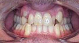Elijah-Before-Teeth