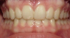 Julia-After-Teeth