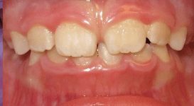 Luke-After-Teeth
