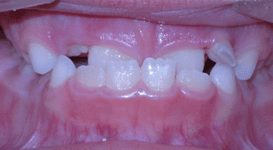 Luke-Before-Teeth