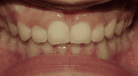 Xaiver-After-teeth