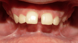 Xaiver-Before-teeth
